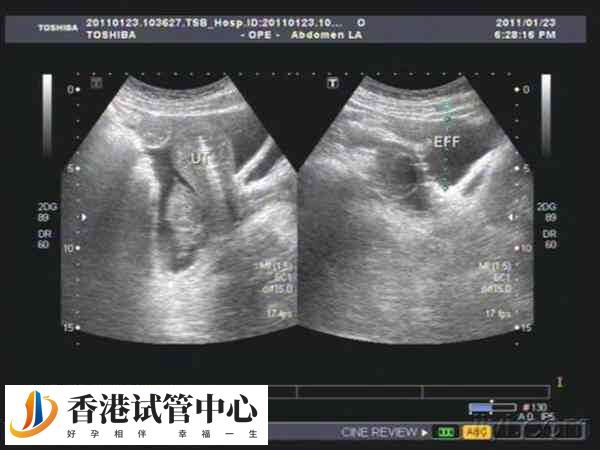 28個卵泡做試管成功率高不高