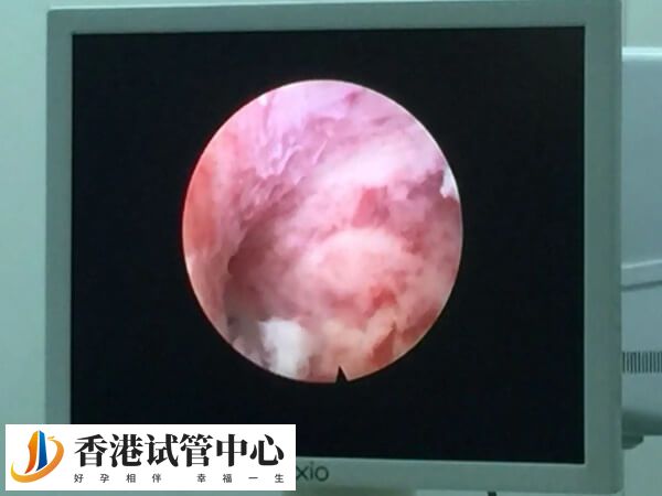 試管嬰兒中做宮腔鏡檢查有什么作用